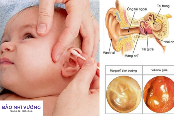 viêm tai giữa thủng màng nhĩ