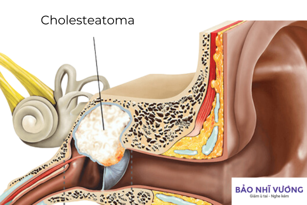 cholesteatoma