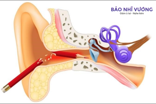 tắc nghẽn ống tai