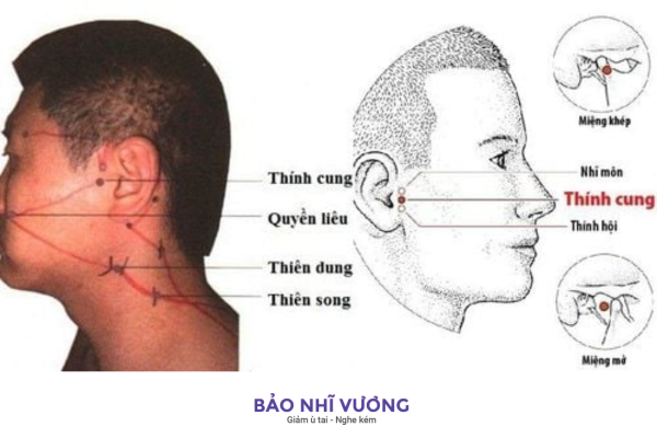 bấm huyệt trị ù tai