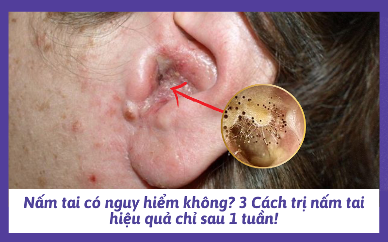 Nấm tai có nguy hiểm không? 3 Cách trị nấm tai hiệu quả chỉ sau 1 tuần!