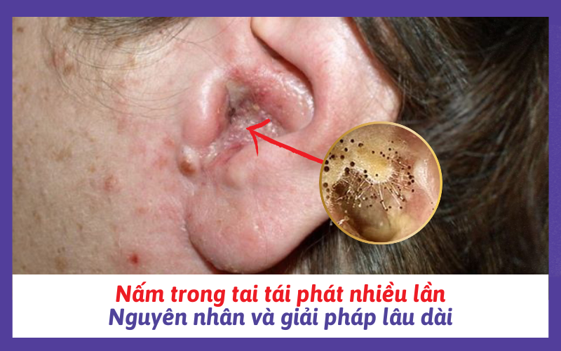 Nấm trong tai tái phát nhiều lần: Nguyên nhân và giải pháp lâu dài