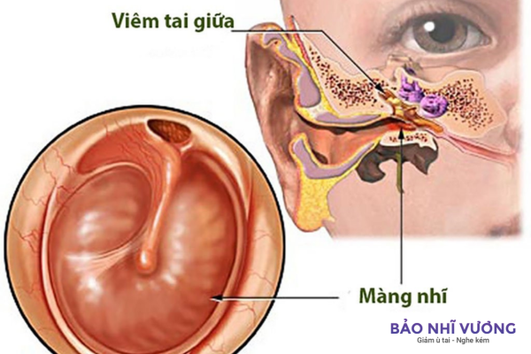 ù tai do thủng màng nhĩ