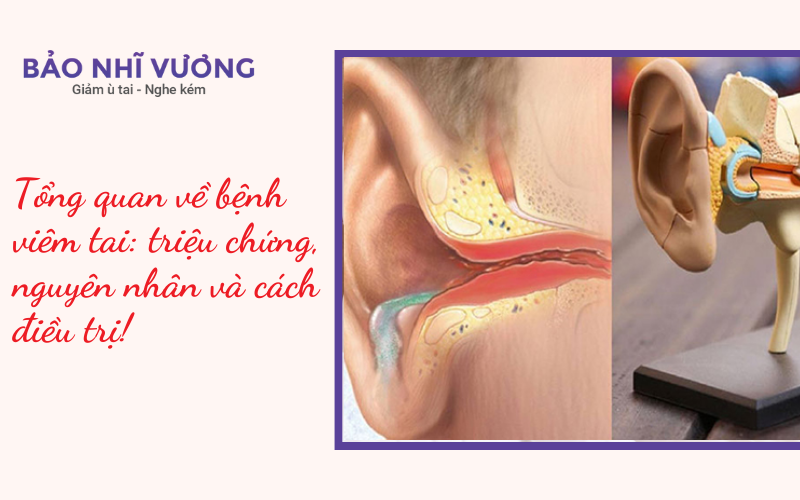 Tổng quan về bệnh viêm tai: triệu chứng, nguyên nhân và cách điều trị!