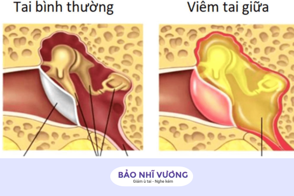 viêm tai giữa