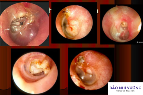 các giai đoạn viêm tai giữa