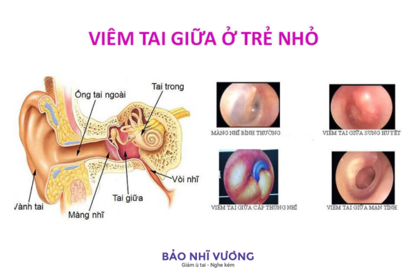 viêm tai giữa thủng màng nhĩ