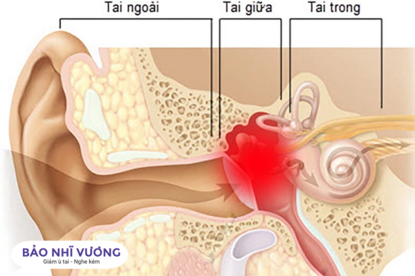 viêm tai giữa