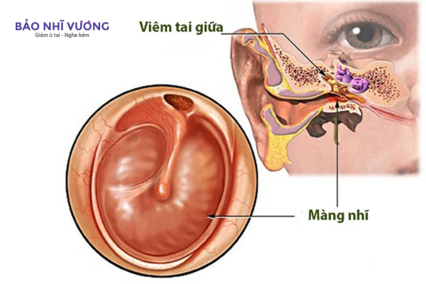 thủng màng nhĩ