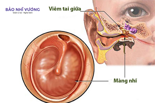 viêm tai giữa thùng màng nhĩ